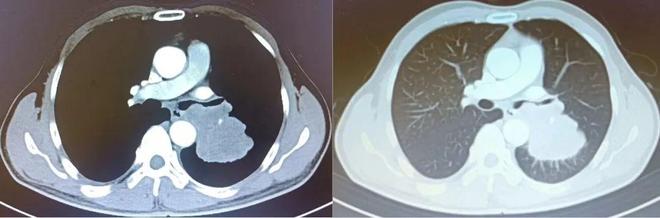 福建男子咳嗽一个月没在意一查确诊癌症！医生：太惊险了！(图1)