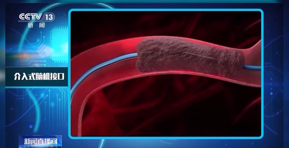 我国脑机接口技术走向临床 受试者体验如何？(图10)