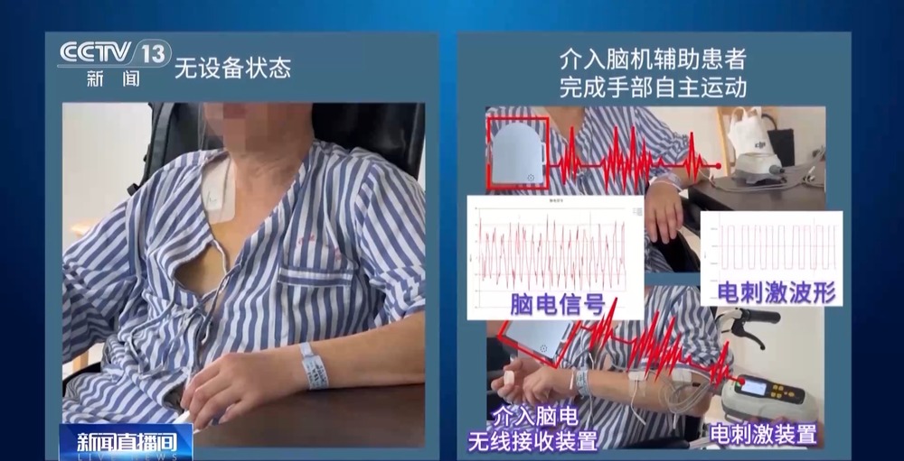 我国脑机接口技术走向临床 受试者体验如何？(图4)